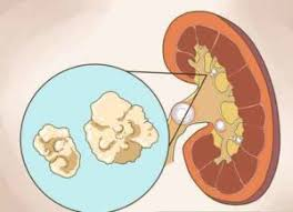 Illustration for article titled Obat Penghilang Nyeri Karena Batu Ginjal